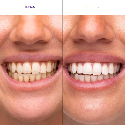 Viral hismile v-34 Whitening Strips