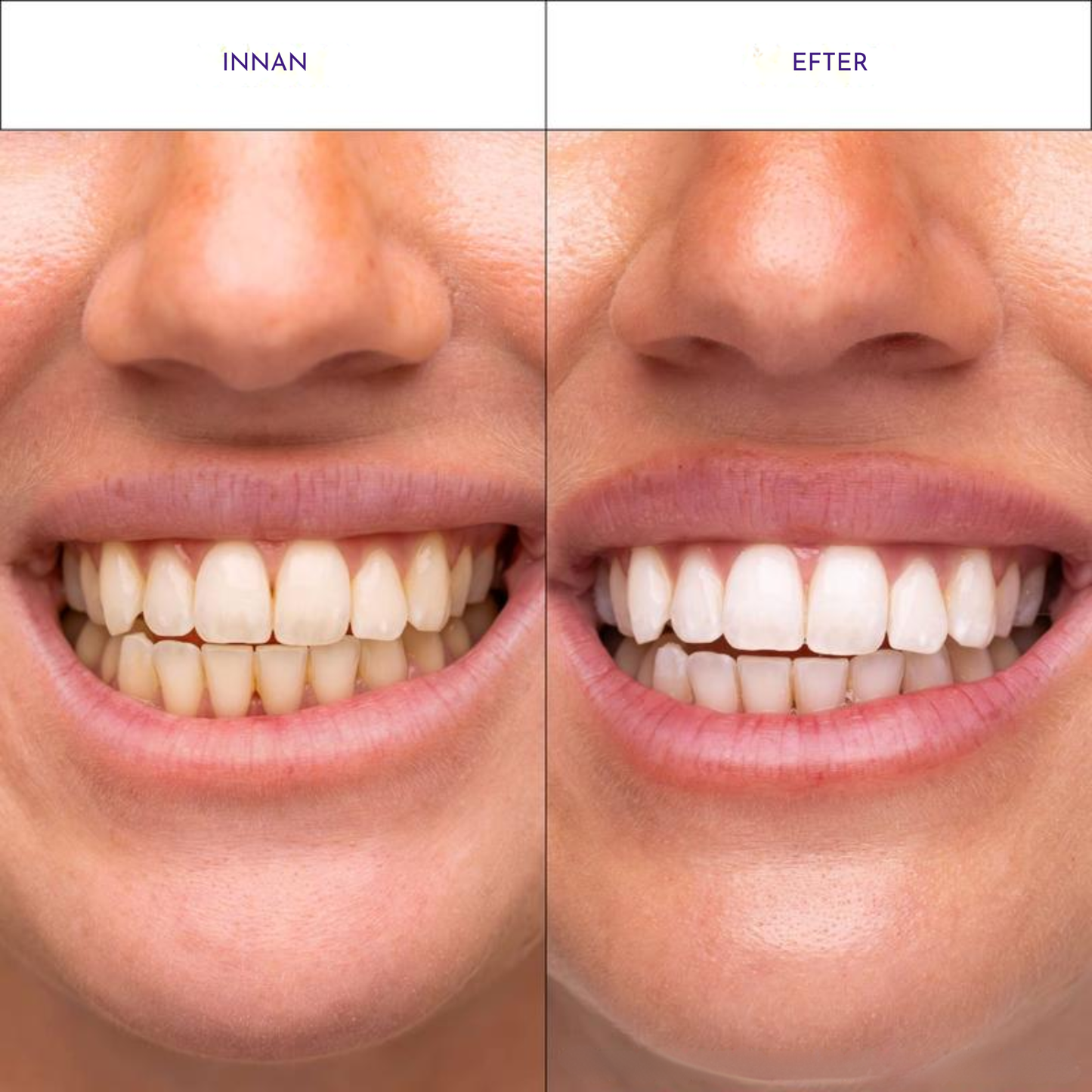Viral hismile v-34 Whitening Strips