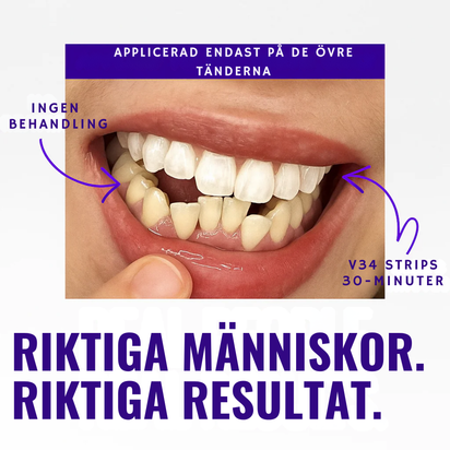 Viral hismile v-34 Whitening Strips