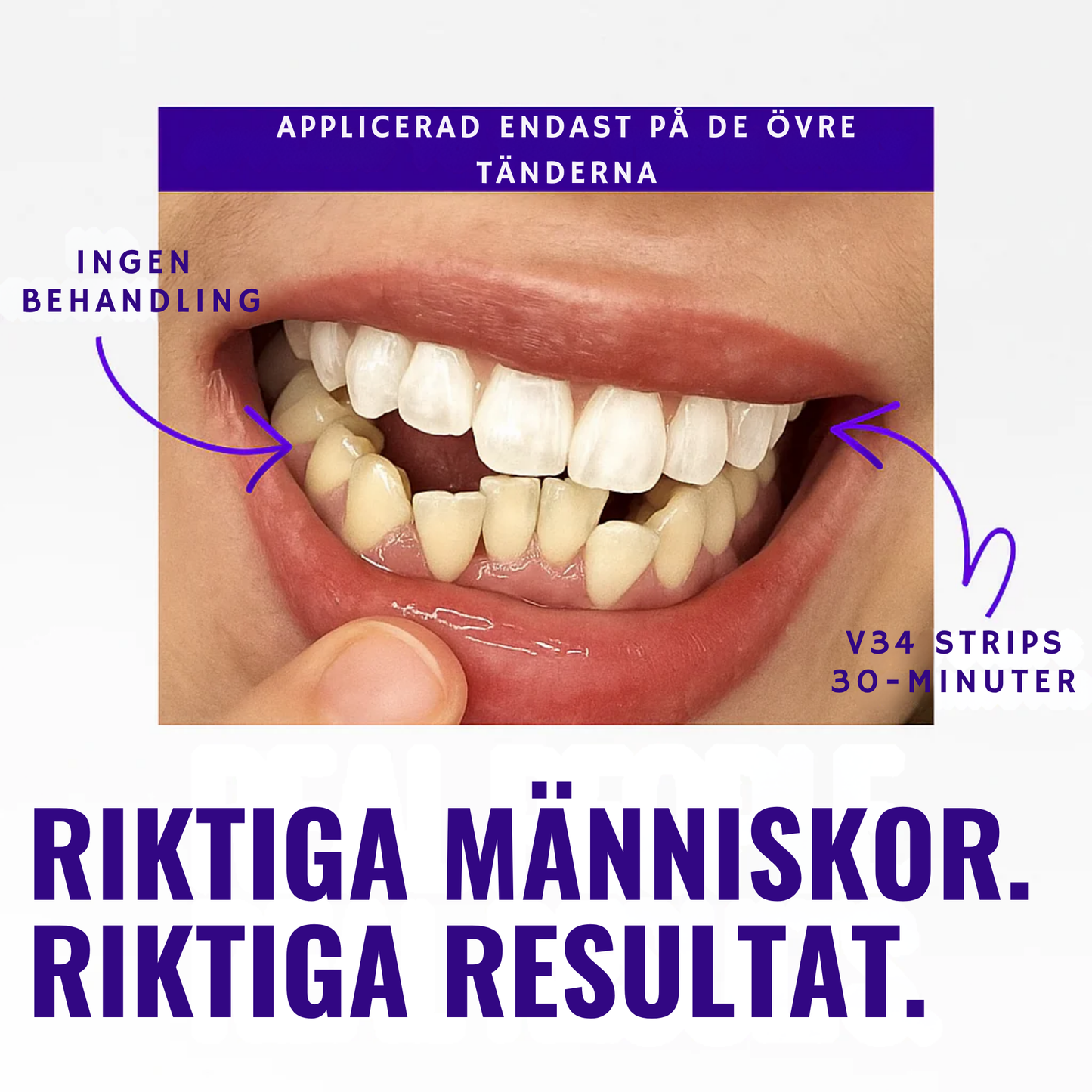 Viral hismile v-34 Whitening Strips