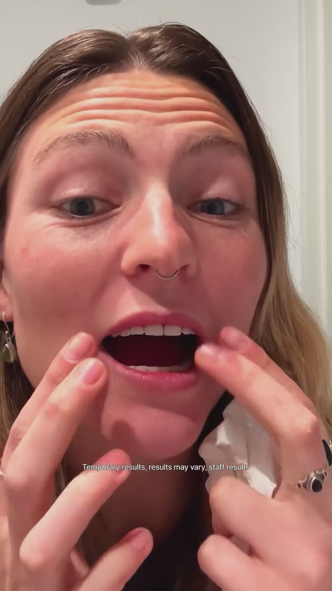 Viral hismile v-34 Whitening Strips video