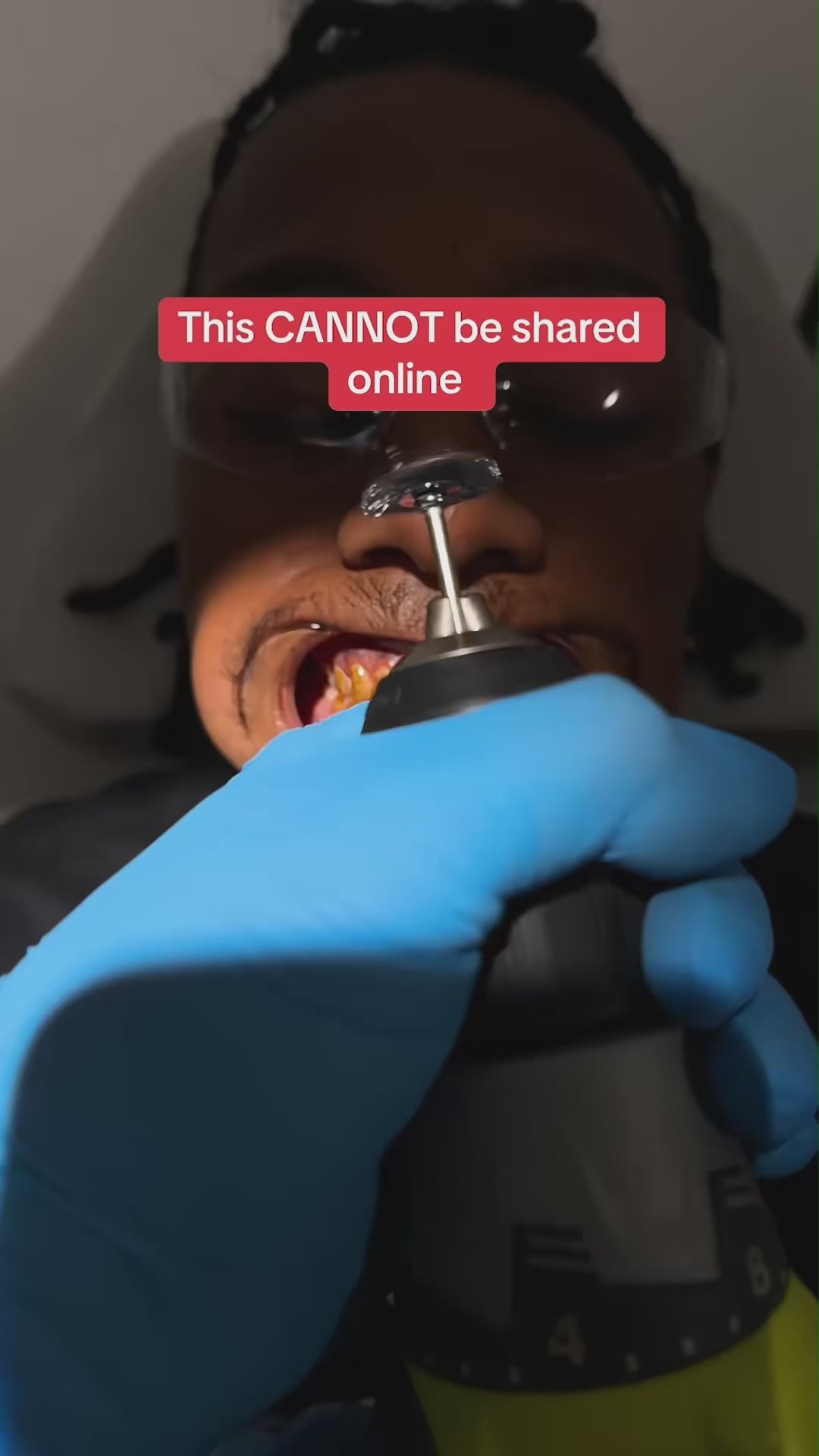 Viral hismile v-34 Whitening Strips video